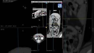 米地のCT読影　門脈体循環シャントをさがせ