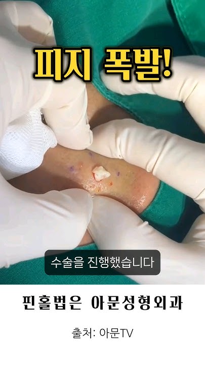 피지 폭발? (볼 멍울 낭종 압출 핀홀법 피지낭종 표피낭종 수술 피부과 성형외과 병원 Epidermal Cyst Surgery ...