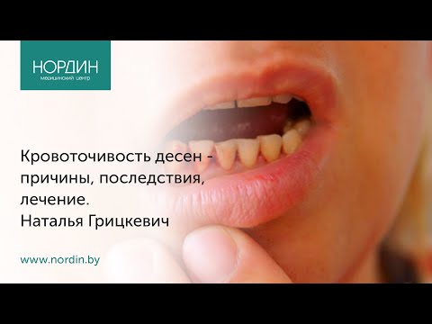 Кровоточивость десен - причины, последствия, лечение