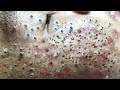 Feel The Extraction Through The Screen | Pimple Popping #800181