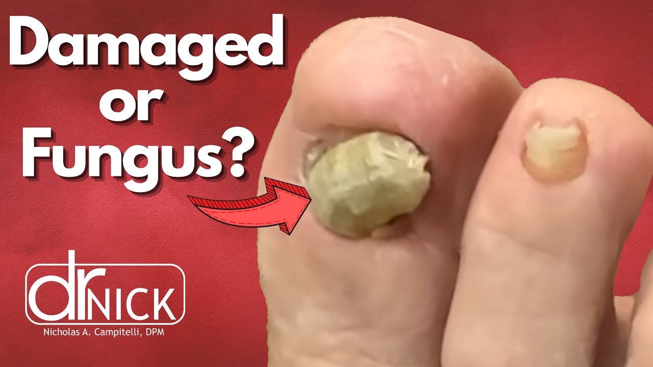 How To Fix A Deformed Toenail YouTube how-to-fix-a-deformed-toenail-youtube