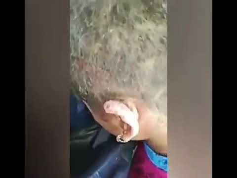 LICE ATTACK