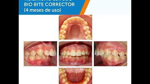 BIO BITE CORRECTOR