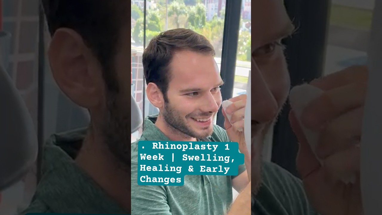 Rhinoplasty 1 Week | Swelling, Healing & Early Changes