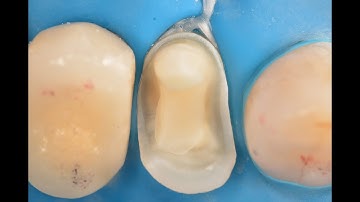 Cerec Overlay: Fully digital restoration at BAU Faculty of Dentistry