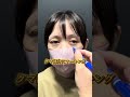 【目の下のクマ取り】の手術の前後 | ビフォーアフター動画