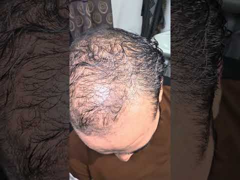 Hair Exosome results