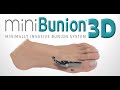 Minibunion 3d  mis bunion system with viking instrumentation