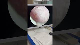 Professional Earwax Removal Procedure 😍 | Safe Deep Ear Cleaning #ENTClinic #Doctor #Shorts