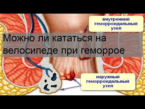 Можно ли кататься на велосипеде при геморрое