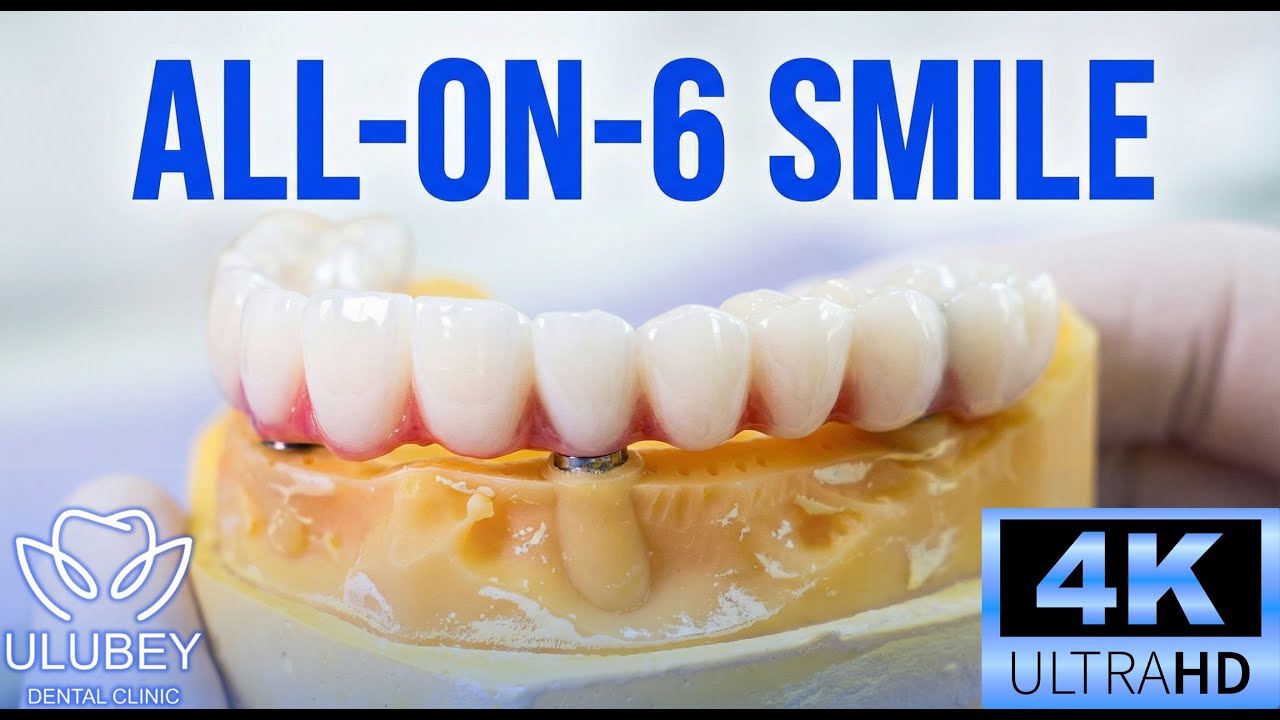 Full Smile Reconstruction with All-on-6 | All-on-6 ile Tam Gülüş Tasarımı