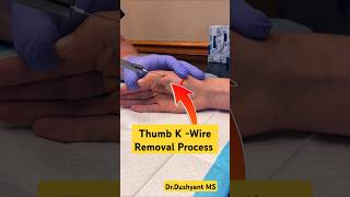 Thumb K -Wire Removal अंगूठे se तार निकाला 🔥 #thumb #hardware #fracture #fracturerecovery #bone