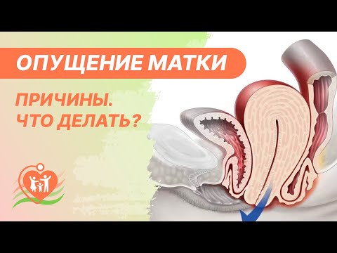 Видео: Может ли выпасть шейка матки?