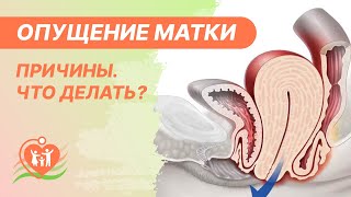 ⭕ Опущение матки. Причины. Чем грозит опущение или выпадение матки и что делать?