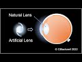 Intraocular Lens Implants 1: Inspiration and Development