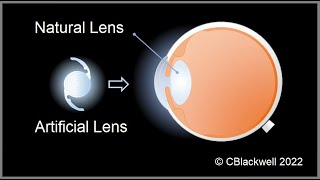 Intraocular Lens Implants 1: Inspiration and Development