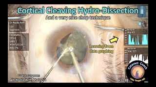 CataractCoach 1298: cortical cleaving hydro-dissection and intra-op metrics