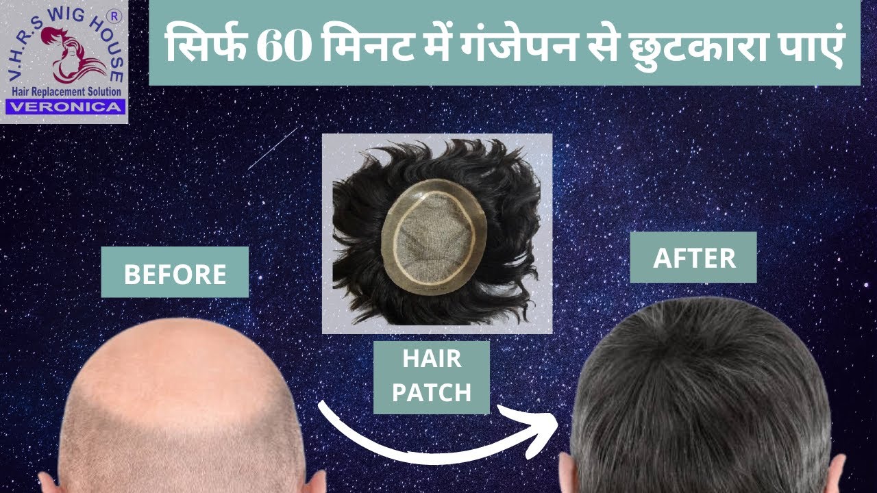 Get Rid Of Baldness With Veronica Hair Replacement #hairreplacement  #besthairwigs #hairpatchfixing - YouTube