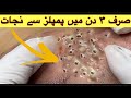 Pimples Removal on face at home|blackheads new this week |new blackhead this week