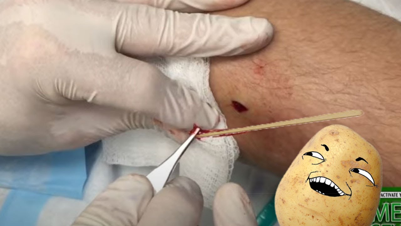 Toothpick Removal from Leg YouTube