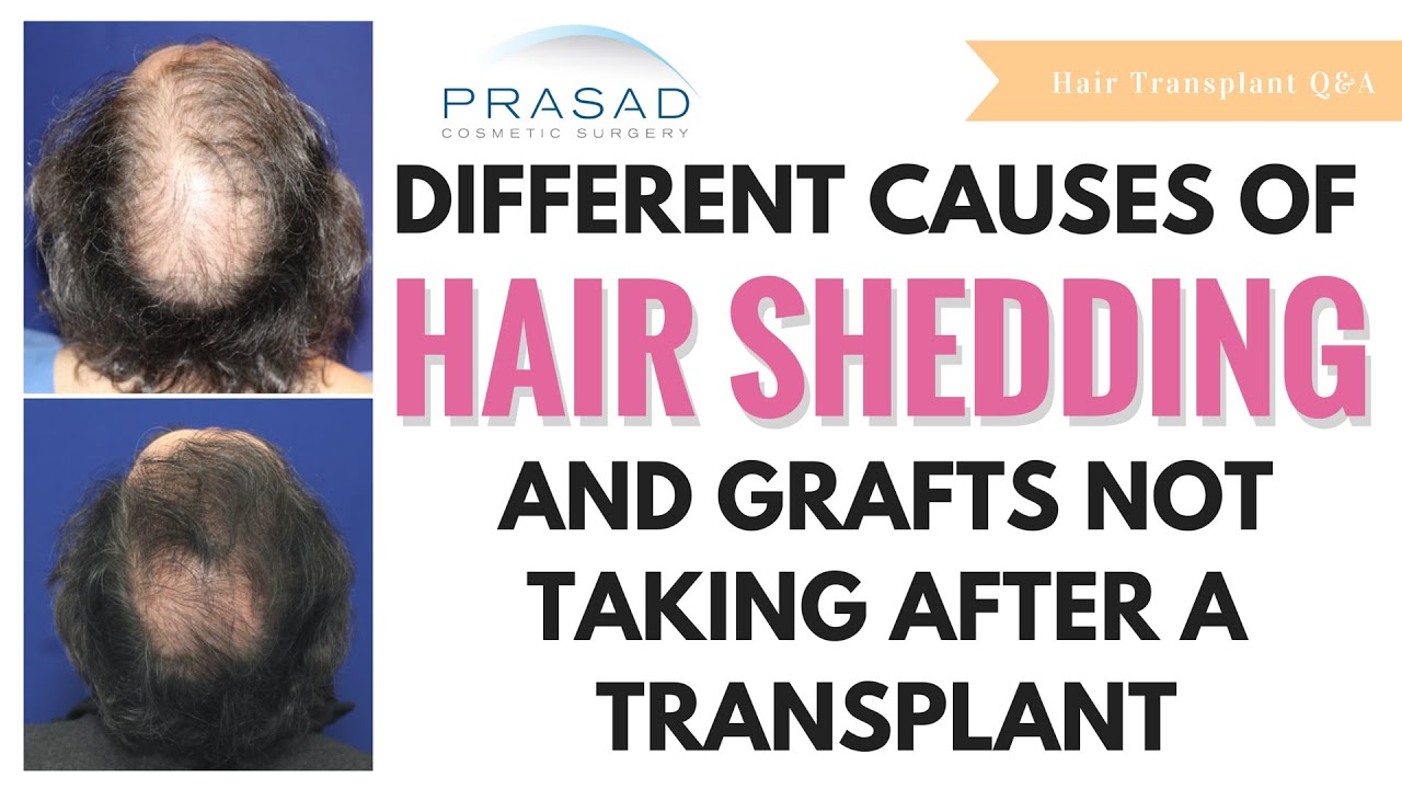 Different Causes of Hair Shedding after a Transplant, and Chances of Grafts  Not Taking - YouTube