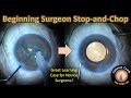 Beginning Surgeon Stop-and-Chop Cataract Surgery Case