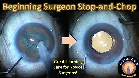 Beginning Surgeon Stop-and-Chop Cataract Surgery Case