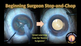 Beginning Surgeon Stop-and-Chop Cataract Surgery Case