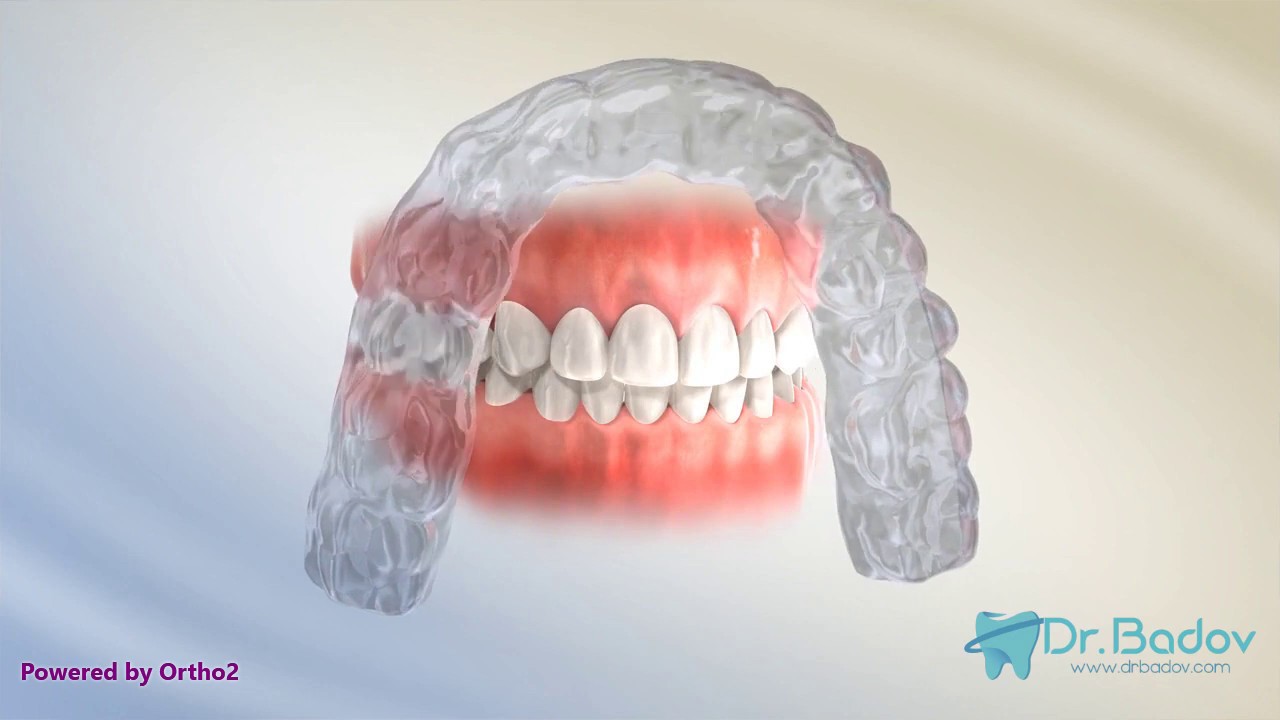 #ортодонт #брекети #ритейнър  Ритейнър след брекети