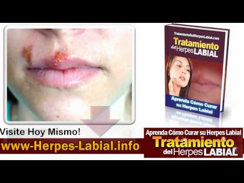Herpes En La Boca En Ninos Tratamiento Del Herpes Labial Youtube