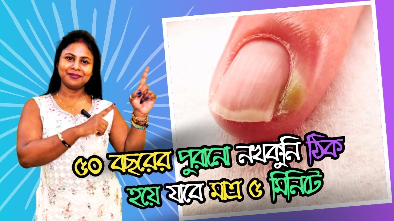 ৫০ বছরের পুরানো নখকুনি ঠিক হয়ে যাবে মাত্র ৫ মিনিটে 😲 ঘরোয়া উপায়ে নখকুনি থেকে মুক্তি 😍 #yt #viral