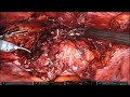 Robotic surgery placement of Artificial Urinary Sphincter at bladder neck