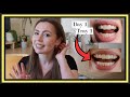 Invisalign progress update    gum recession gap teeth black triangles  delays