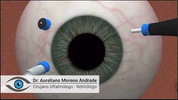 Vitrectomy animation | Retina Center Tijuana
