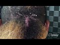 💜 Full Head Scratch Dandruff Scratching: Shaved Sides Big Flakes w/ CojonaJ  & Carlito Black