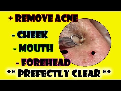 #cyst topic Acne Treatment Jully  - Remove Acne From Cheek / Mouth / ForeHead From Horrible Face