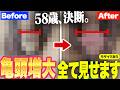【亀頭増大】加齢で小さくなった… 50代男性が決断。リパスG増大治療を全て見せます!