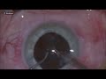 Horizontal  lateral chop soft cataract hydrophobic iol by adrian gavanescu
