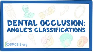 Dental occlusion  Angle’s classifications