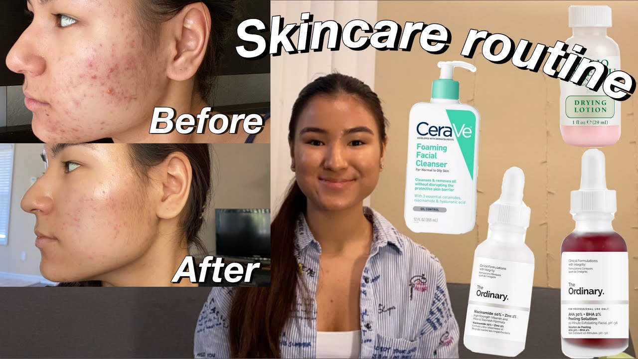 HOW TO GET RID OF ACNE AND TEXTURED SKIN/ skincare routine 2020 - YouTube