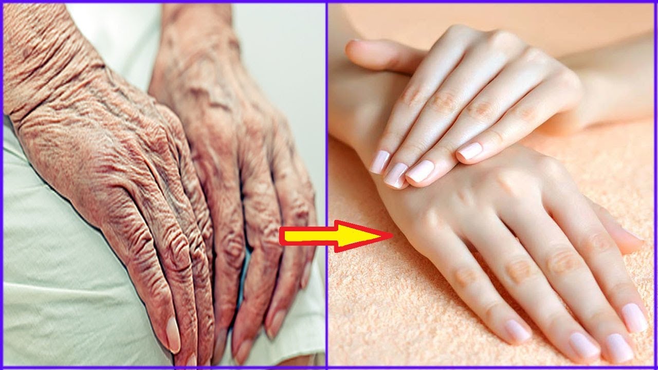 Remove Wrinkles On Hands - Make Your Hands Look 10 Years Younger - Get ...
