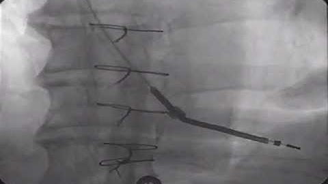 Laser lead extraction