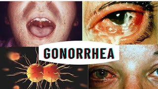Gonorrhea - symptoms, causes, diagnosis & how to prevent. screenshot 4