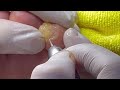 【小指が横に向いている方必見】小指横に密集していた魚の目を取り除く映像#鶏眼#魚の目