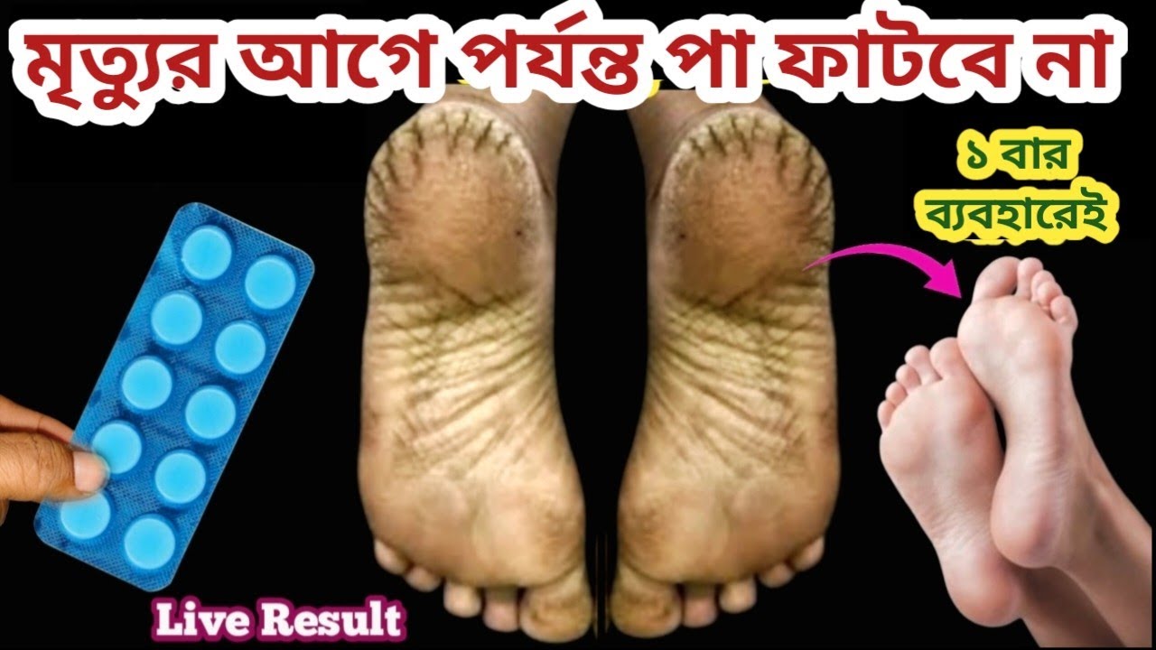পা ফাটা থেকে মুক্তি পাওয়ার ঘরোয়া পদ্ধতি/cracked heels treatment/ kitchen tips & hacks