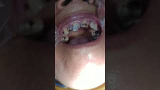 root canal treatment 1 2 3  6 6
