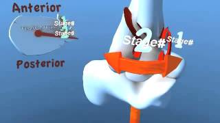 Lauge Hansen SER Supination External Rotation Eversion Ankle Fracture