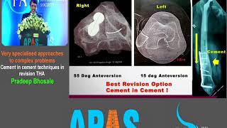 APAS 2017 DAY 3 76 - OrthoTV