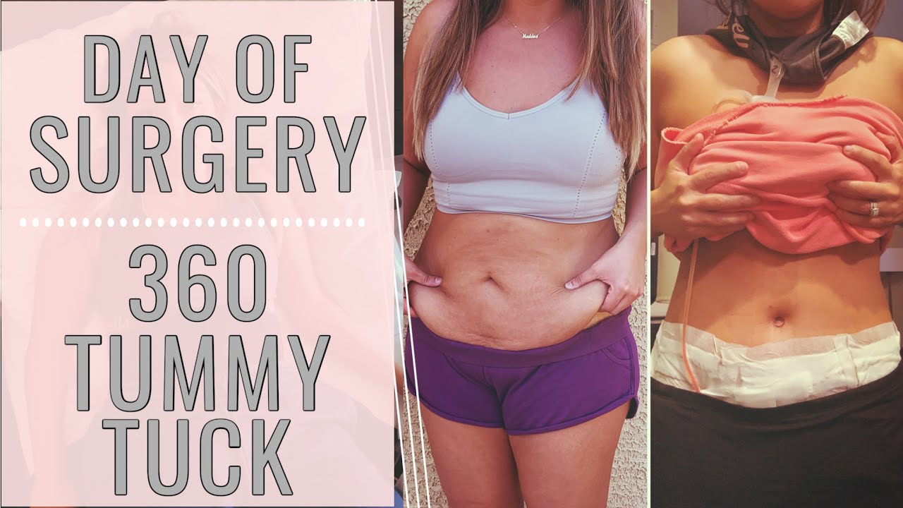 360 TUMMY TUCK SURGERY DAY! RECOVERY YouTube