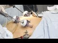 Laparoscopic Gastric Bypass Surgery